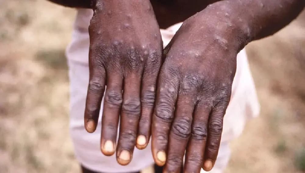 فنلندا تسجل أول حالة بجدري القردة