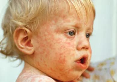 هل اقتحمت الحصبةُ مخيماتِ طرابلس؟
