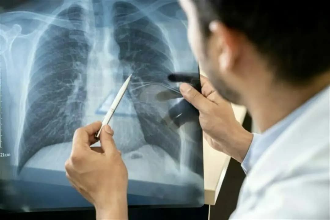 متلازمة الرّئة البيضاء... هل ظهرت "كورونا" الجديدة؟