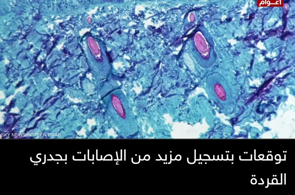 بعد القلق.. منظمةُ الصحة العالمية تشير إلى أنه "لا دليل عن تحوّرات جدري القرود"