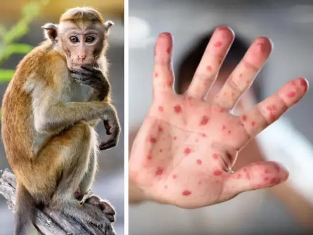 الصحة العالمية تُحذّر من انتشار جدري القردة في الدول التي لا يتوطن فيها