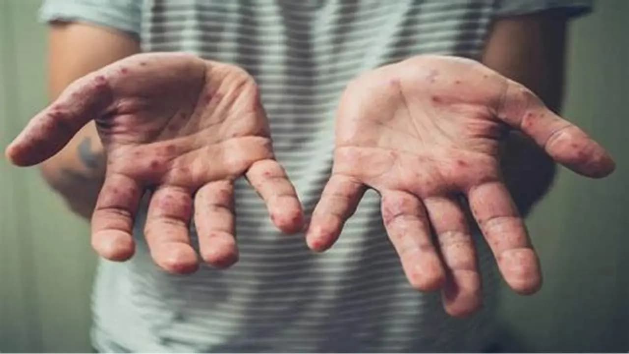 الصحة العالمية قلقة من انتشار فيروس "إم بوكس"