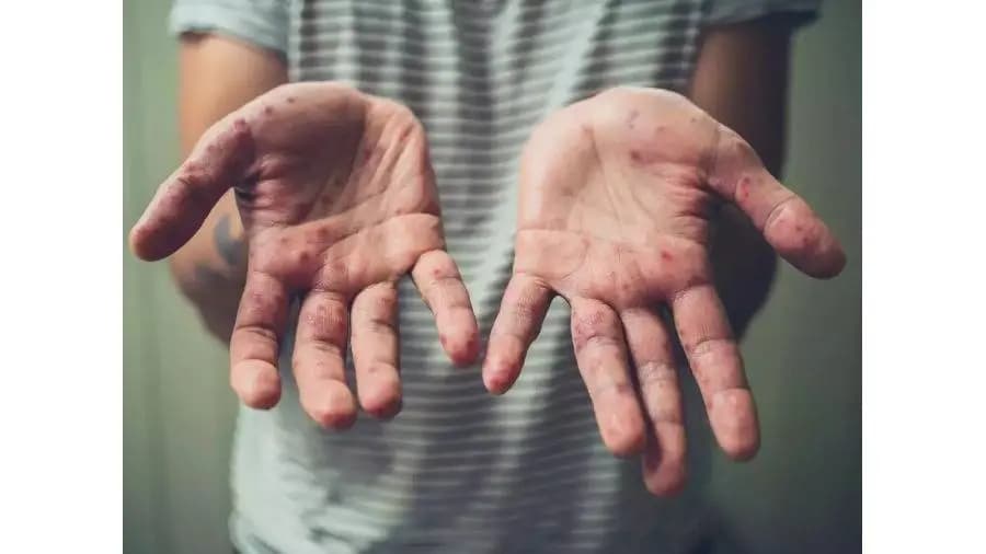 "بعد إعلان حالة الطوارئ".. تعرف على عوارض جدري القردة