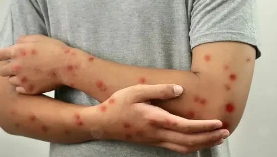 بحلول نهاية 2025.. لقاح جدري القرود سيكون متوفرًا