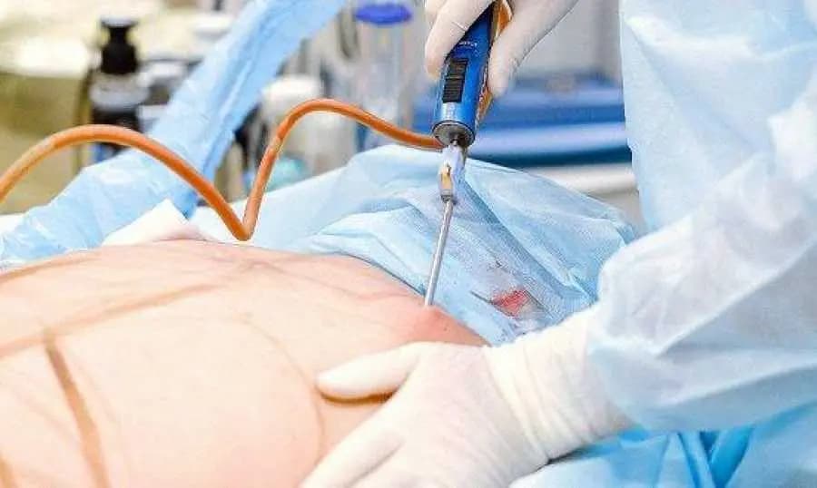 عمليّة شفطِ دهون تقود 4 أطباء إلى السّجن... إليكم التّفاصيل