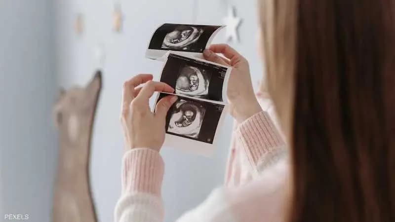 جنين متحجّر يتسبب بوفاة امرأة... إليكم القصة..