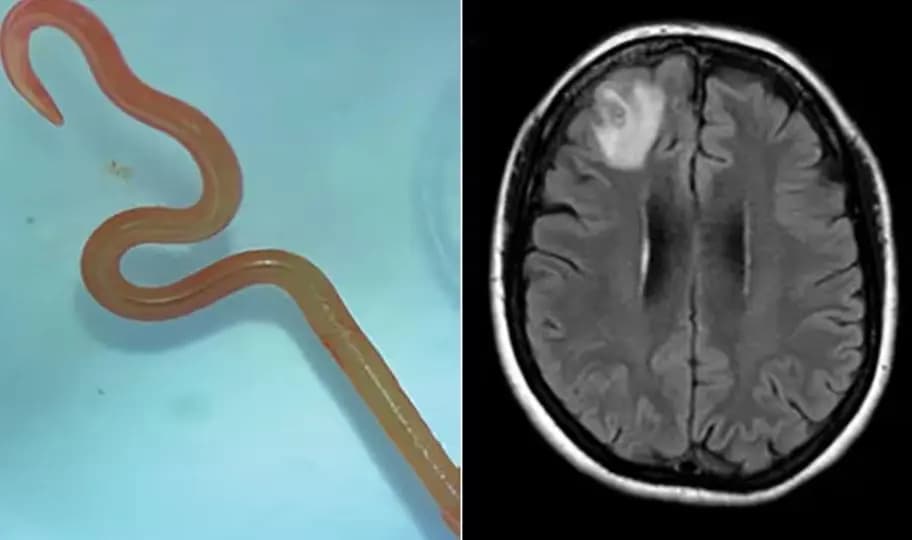 لأوّل مرّة في العالم.. دودة حيّة في دماغ امرأة